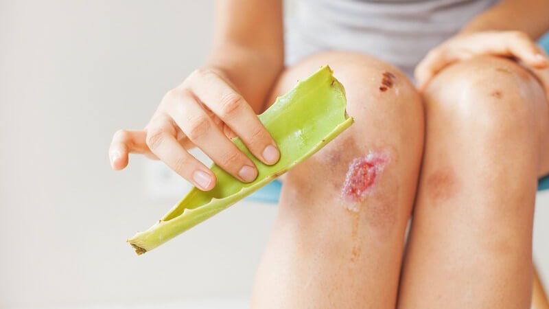 Frau verarztet ihre Wunde am Knie mit einem Aloe vera-Blatt