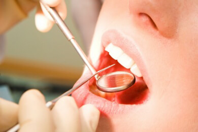 Wenn Steinchen die Ausführungsgänge der Speicheldrüsen verschließen