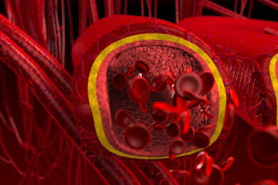 Risikofaktor für eine Venenthrombose entdeckt