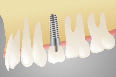 Richtige Pflege erhält Implantate über viele Jahre