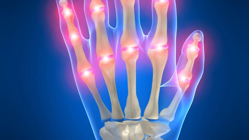 3D Grafik Skelett linker Hand mit Schmerzpunkten