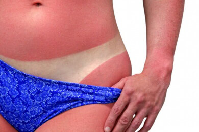 Sonnenbrand - und was nun?