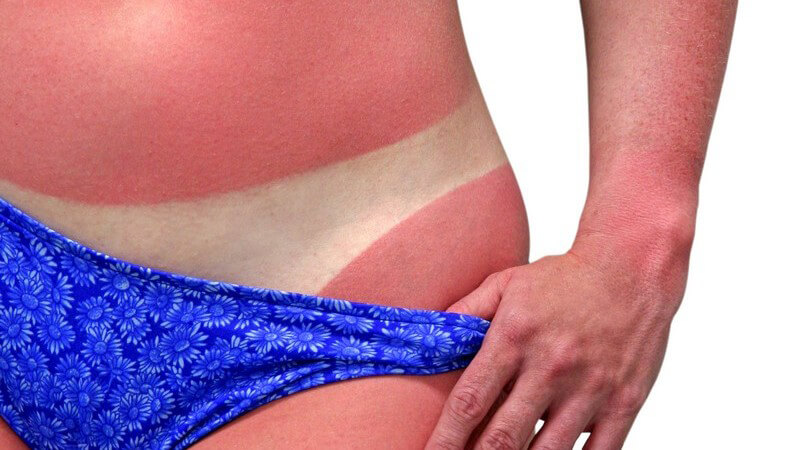 Frau mit extremem Sonnenbrand, zieht Bikinihose ein bisschen runter