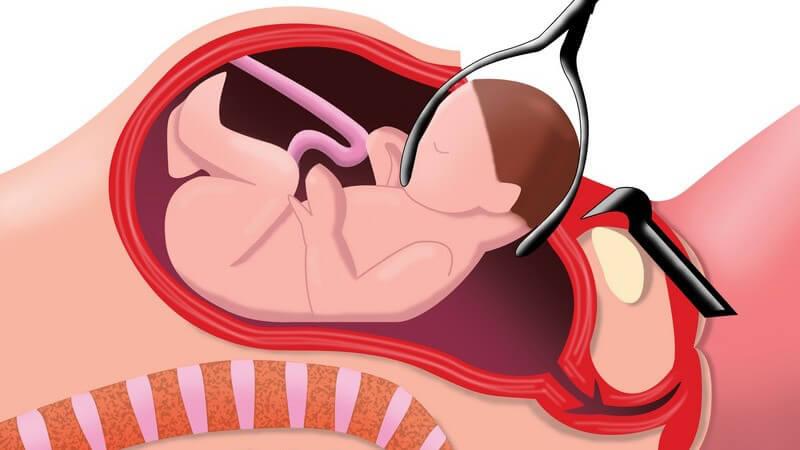 Zeichnung Geburt, Kind wird mit Zange via Kaiserschnitt geboren