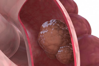 Die Psyche und deren Einfluss auf eine Krebserkrankung