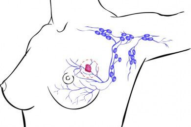 Neues ATM-Gen als Faktor für Brustkrebsrisiko entdeckt