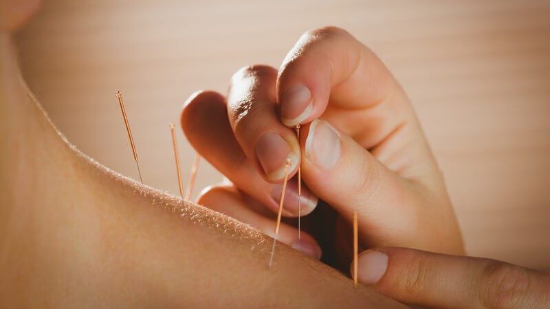Akupunkturnadeln werden in eine Schulter gepiekst