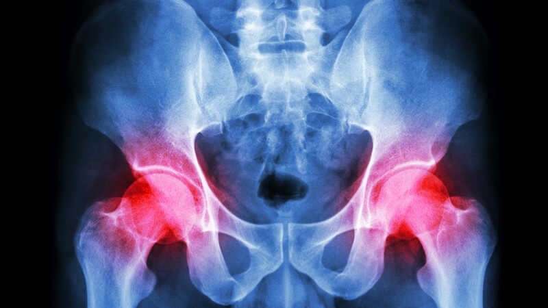 Röntgenbild eines menschlichen Beckens mit Arthritis in der Hüfte, rot gekennzeichnet
