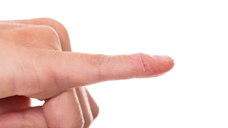 Nahaufnahme einer Hand mit ausgestrecktem kleinen Finger mit trockener, kaputter Haut