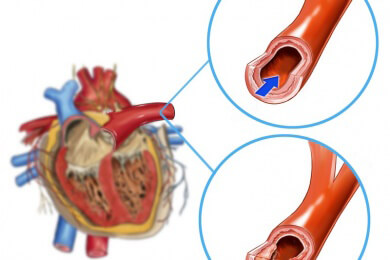 Durchbruch in der Bypass-Medizin: Künstliche "Spaghetti-Arterie" gleicht einer echten