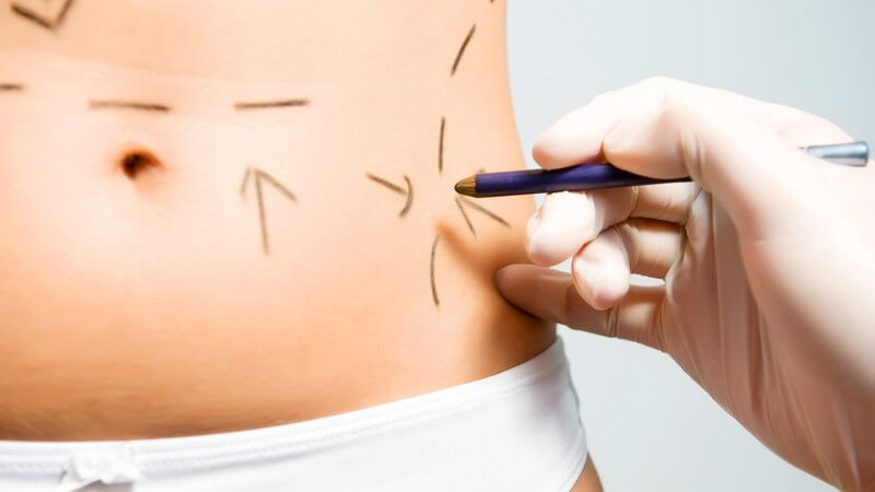 Bauch einer Frau wird vor Schönheitsoperation mit Stift gekennzeichnet