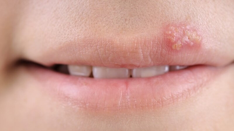 Nahaufnahme Lippen mit Herpes