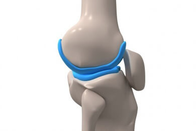 Sport mit Knieprothese schädigt das künstliche Gelenk seltener als gedacht