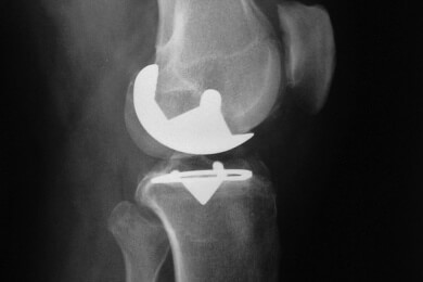 Auch mit Knieprothesen kann man Sport treiben