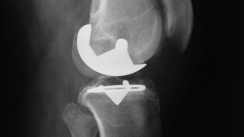 Röntgenbild eines Knies mit Platten