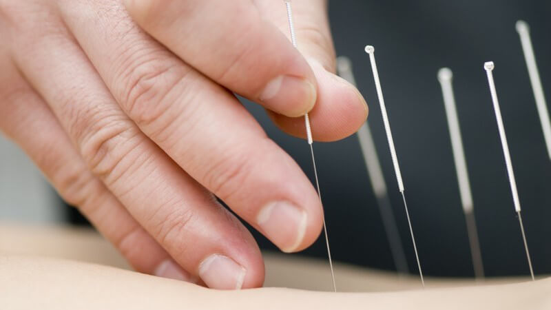 Nahaufnahme Hand sticht Akupunktur Nadeln