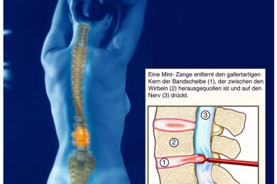 Nur wenige Ärzte wissen über moderne Behandlungsmethoden bei Bandscheibenvorfällen bescheid