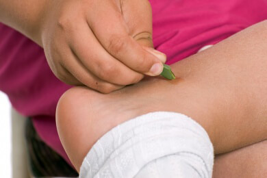 Behandlung von Mückenstichen