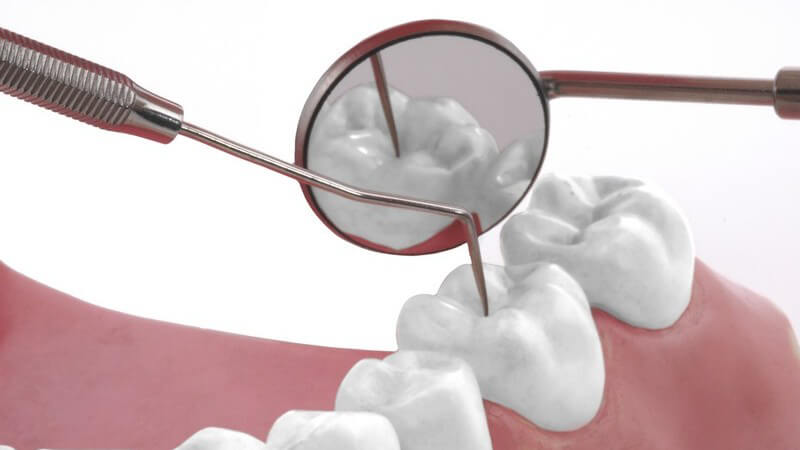 Zahnmodell, dass mit Mundspiegel und Kürette untersucht wird