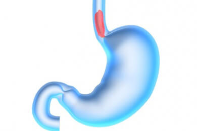 Risiko an  Speiseröhrenkrebs zu erkranken steigt durch die Einnahme von Osteoporose-Medikamenten