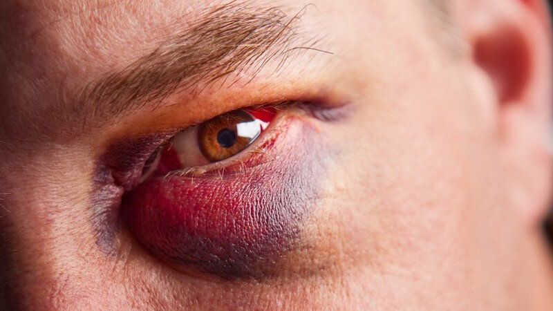 Nahaufnahme Männergesicht, linkes Auge Blut unterlaufen