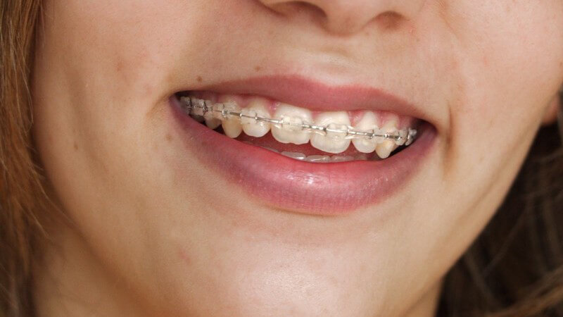 Lächeln eines Mädchens mit fester Zahnspange