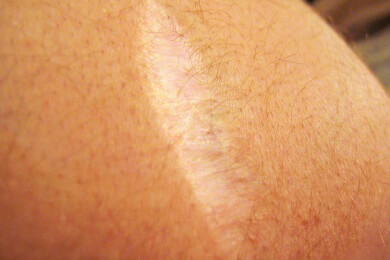 Neue Wege in der Narbenbehandlung - Lasertherapie macht Haut wieder schön