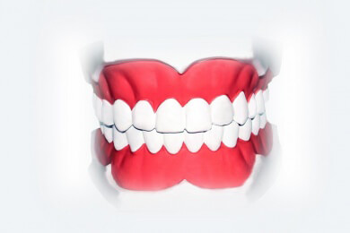 Omega-3-Fettsäuren verringern das Risiko einer Parodontose