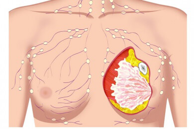 Röntgen und Bildgebung zur Krebsdiagnose - weniger Biopsien nötig durch kombinierte Untersuchung