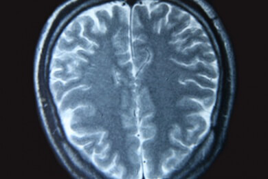 Sauerstoffmangel im Gehirn durch eine Schlafapnoe