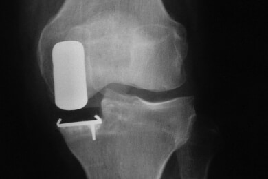 Durch Arthrose zerstörte Knorpel könnten durch ein Implantat zu neuem Wachstum angeregt werden