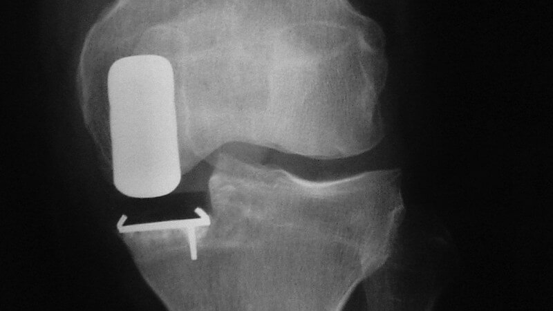 Röntgenbild eines Knies mit einer Platte