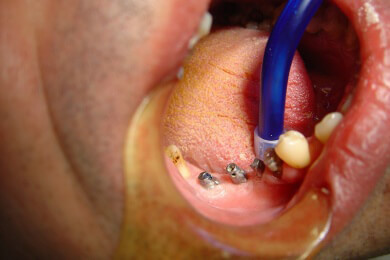 Beschwerden von Patienten - Zahnärzte werden immer öfter mit Haftungsansprüchen konfrontiert