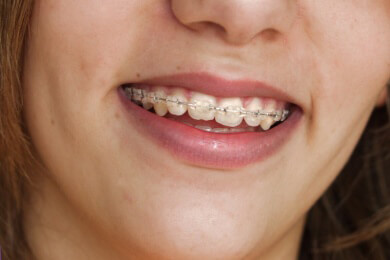 Verschiedene Zahnspangen für Kinder und Jugendliche