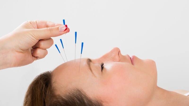 Frau erhält Akupunkturbehandlung an der Stirn, blaue Akupunkturnadeln