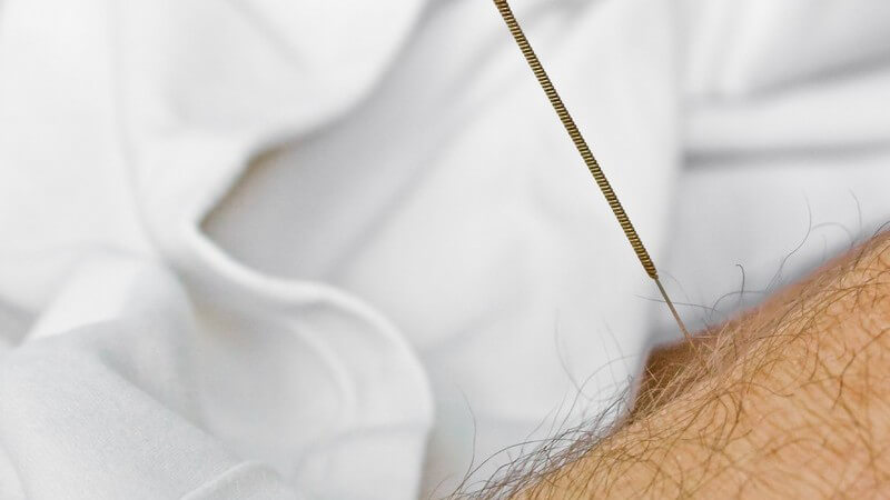 Nahaufnahme Akupunkturnadel in männlichem Arm