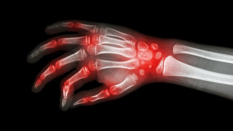 Röntgenbild einer Hand mit Rheumatoider Arthritis an Fingern und Handgelenk, rot hervorgehoben
