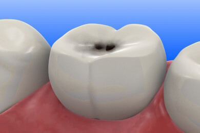 Schutz vor Karies - unser eigener Körper kann sich durch einen Trick oft selbst schützen