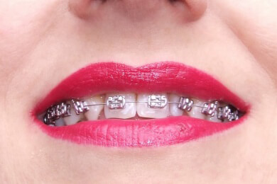 Wenn Erwachsene eine Zahnspange tragen müssen