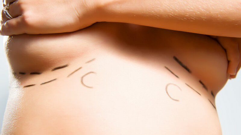 Brustoperation - Eingezeichnete Markierungen unter den Brüsten