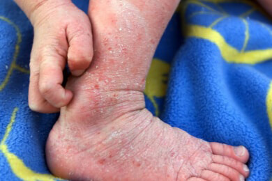 Hyposensibilisierung - Was gegen Allergien hilft, könnte auch gegen Neurodermitis eingesetzt werden