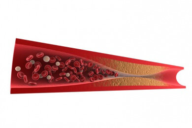 Bei ägyptischen Mumien wurde Arteriosklerose festgestellt
