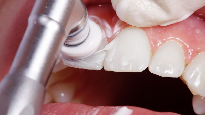 Zahnbehandlung: Zähne werden poliert