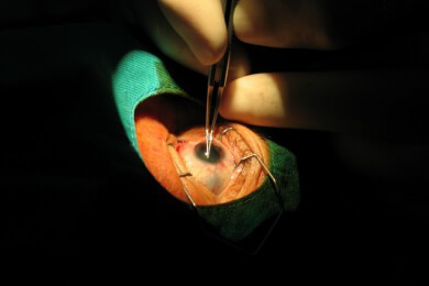 Schmuck ins Auge transplantieren lassen
