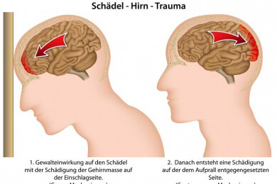 Muss bei einem Schädel-Hirn-Trauma immer ein Teil der Schädeldecke entfernt werden?
