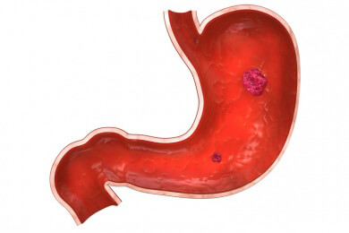 Spanische Studie - Hoher Bierkonsum steigert Magenkrebsrisiko