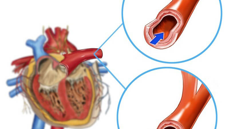 Zeichnung Anatomie menschliches Herz mit verstopfter und freier Arterie
