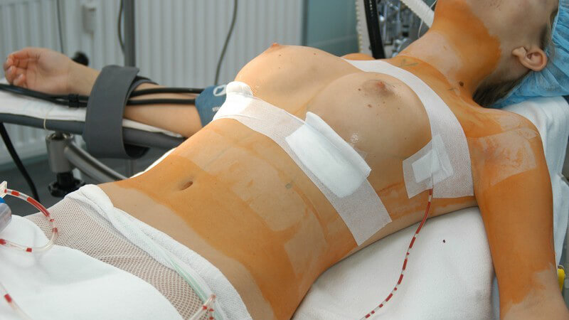 Frau mit nacktem Oberkörper liegt im Operationssaal nach Brustvergrößerung