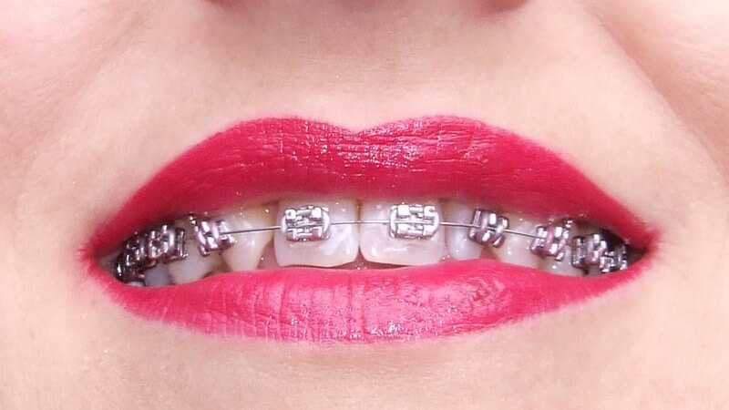 Frauenmund mit rot geschminkten Lippen, Zahnspange