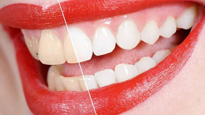 Frauenmund, zur Hälfte gelblich, zur Hälfte weißere Zähne nach Zahnbehandlung